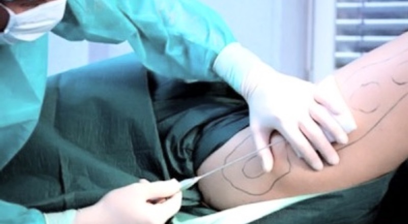 doing liposuction procedure